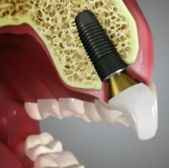 Dental Implants in Kenilworth