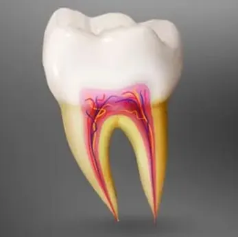 Root Canal Treatment in Kenilworth, NJ